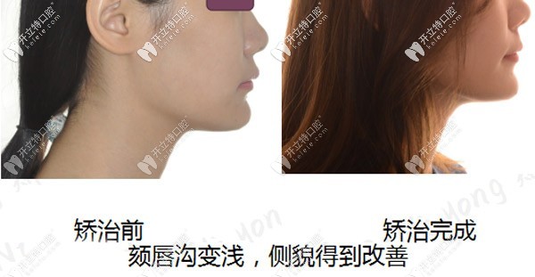從隱適美矯正骨性深覆合的過程看,前后臉型變化確實(shí)不小