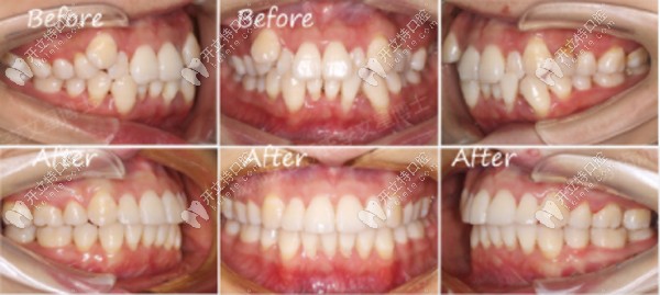 牙列擁擠不齊+個別牙反頜+虎牙矯正案例 牙列擁擠不齊+個別牙反頜+虎牙矯正案例