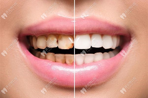 網(wǎng)紅推薦的美白牙貼和瓷貼面美白牙齒的效果比怎么樣?