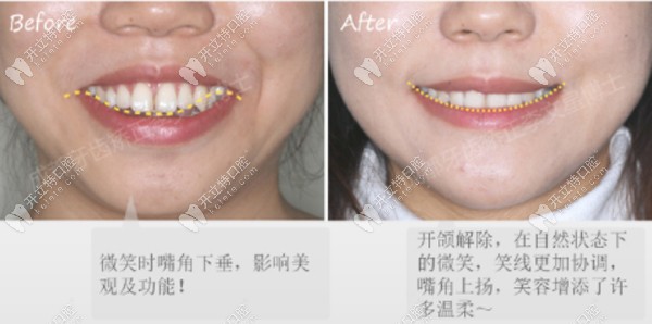 開頜+牙齒中線不齊 開頜+牙齒中線不齊