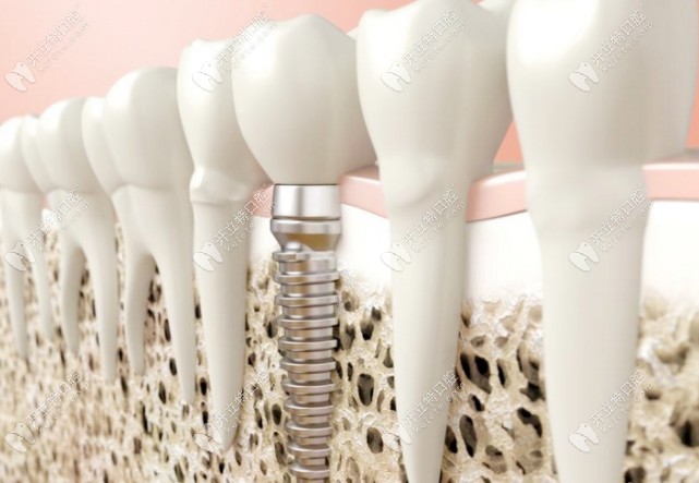 種植體與真牙的區(qū)別