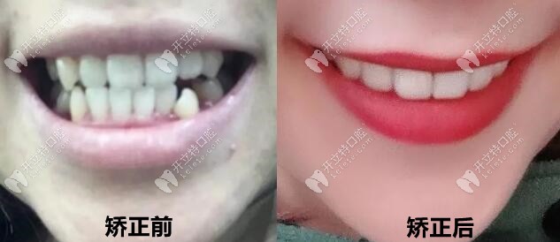 通過3年矯正變化，現(xiàn)在我的牙齒美美噠