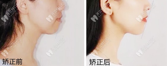 露齦笑戴陶瓷半隱形矯正有效果嗎？親身整牙經(jīng)歷來解答~