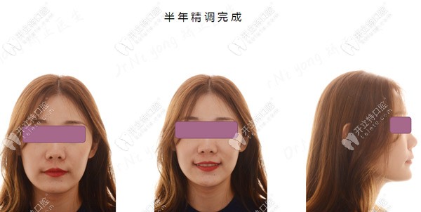 過了半年了，臉型還是有點(diǎn)變化的喲