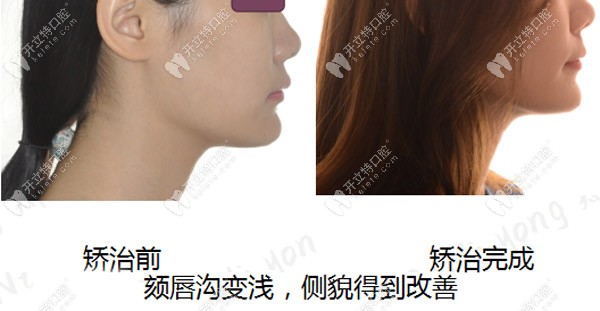 深覆合矯正后頦唇溝變淺，側(cè)臉有了明顯的改善