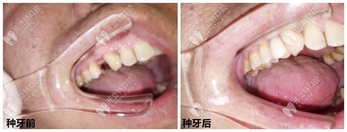 石家莊中諾口腔種牙好嗎？從種牙案例、醫(yī)生技術(shù)來看！