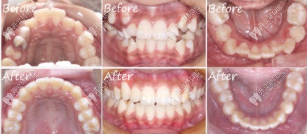 兒童門牙前突+牙列擁擠案例二 兒童門牙前突+牙列擁擠案例二