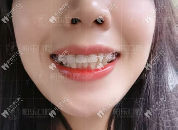 戴陶瓷隱形牙套三個月