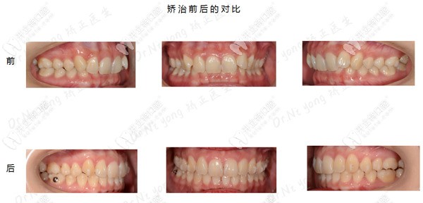牙齒深覆合矯正前后對比