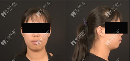 西安鼎秀齒科牙齒矯正案例