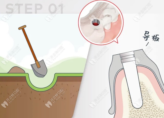 種牙與種樹的對比
