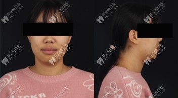 西安鼎秀齒科正畸真人案例