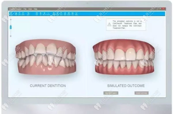 隱形牙齒矯正的3D動畫模擬圖