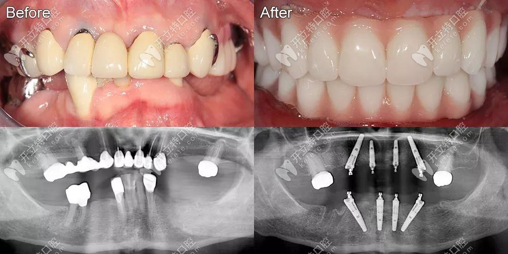 即刻負(fù)重4顆和6顆的真實(shí)區(qū)別已發(fā)放,它的優(yōu)勢(shì)是當(dāng)天戴牙冠