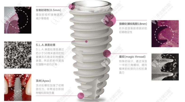 紐百特種植體優(yōu)勢