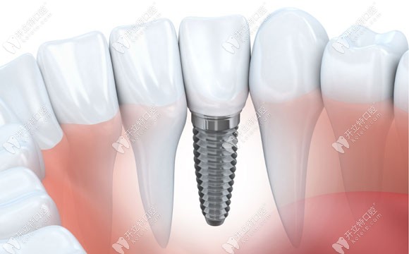 王國(guó)飛醫(yī)生擅長(zhǎng)多種牙齒種植技術(shù)