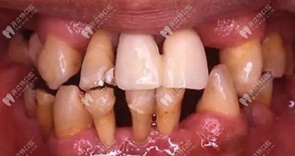 牙齦突然無緣無故出血,當心是牙周炎在作祟！