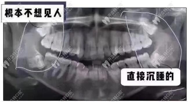 長得很對稱，4顆智齒清潔不到