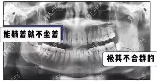阻生牙、阻生智齒（橫著生長）