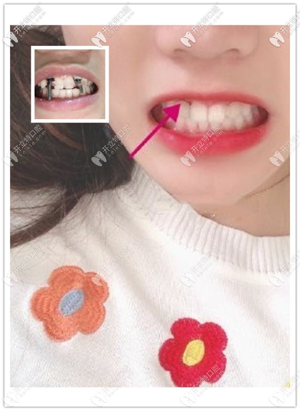 重慶美奧口腔黃澤源醫(yī)生給缺兩顆側(cè)切牙女孩用德國ICX種植體修復成功啦