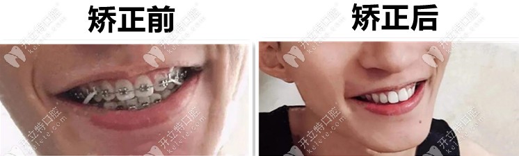 金屬自鎖托槽矯正后前后對比圖