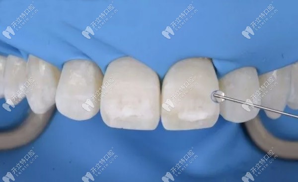 斑點還是存在，需要進一步酸蝕