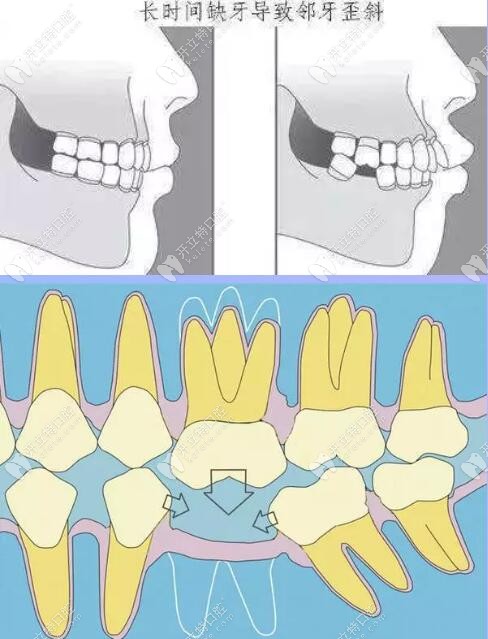 缺牙不種牙的危害