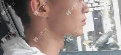 牙齒變整齊了,下頜線也變得更明顯