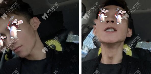 陽光男孩：在長沙德韓口腔做3M金屬托槽矯正