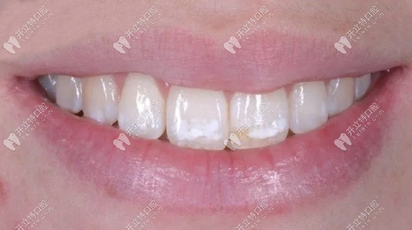 滲透樹脂治療氟斑牙的效果怎么樣，請看案例