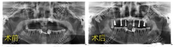 種植牙前后對比