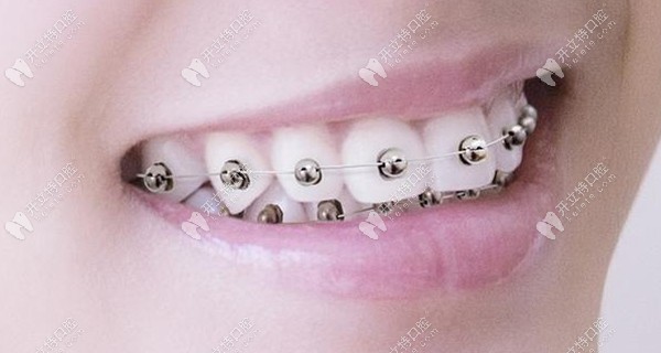 廣州私立連鎖牙科做球面金屬自鎖牙套的優(yōu)惠價(jià)格實(shí)力圈粉~