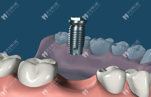 初步植入韓國美格真植體