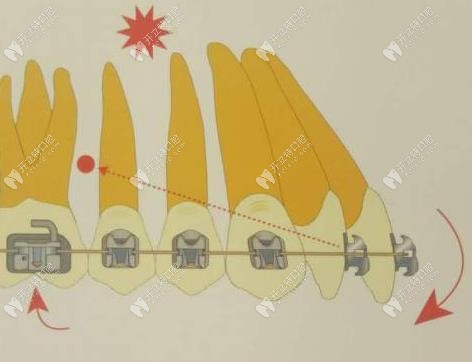 微種植支抗在矯正中施力示意圖