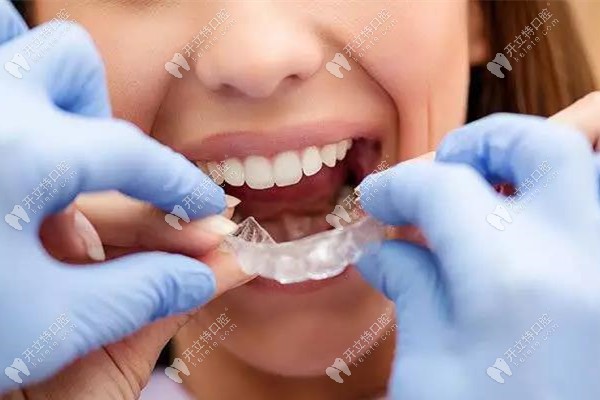 隱形牙套矯正使用圖 隱形牙套矯正使用圖