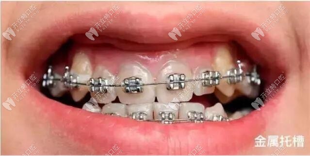 昆明德韓口腔戴普通鋼牙套要多少錢?快問下牙齒矯正價格表