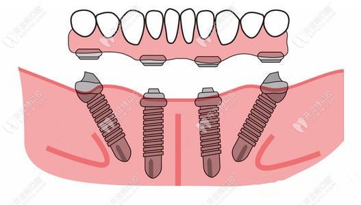 all-on-4半口種植模擬圖
