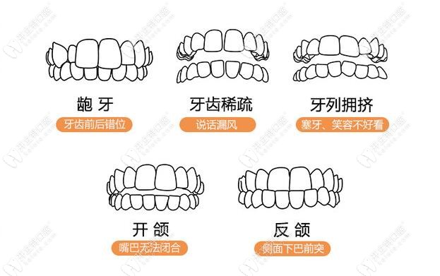 普通鋼牙套針對的癥狀