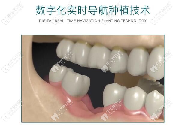 數(shù)字化3D導(dǎo)板種植技術(shù)