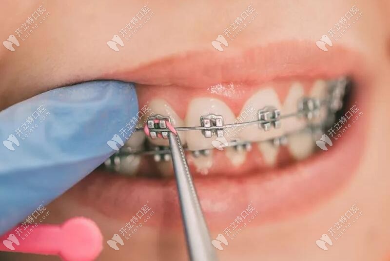 金屬牙齒矯正活動(dòng)