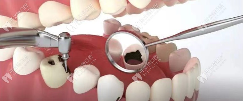 蛀牙不嚴重為什么要及時補牙，窩溝齲黑線是否要補牙呢？