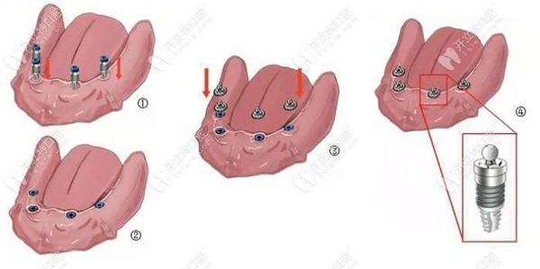 半口半固定的種植過(guò)程