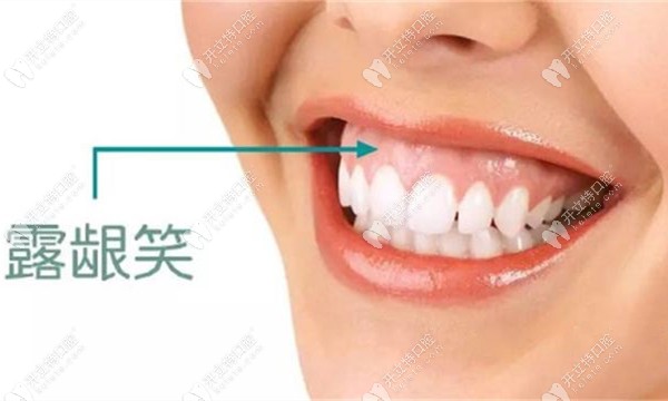 打骨釘可以有效改善露齦笑這我知道,但會不會反彈呢？