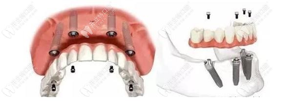 皓清齒科能做半口全口種植 皓清齒科能做半口全口種植