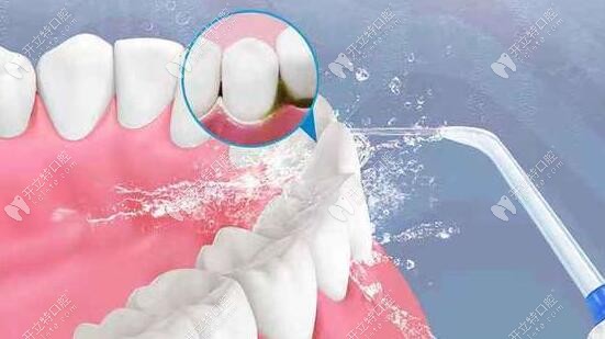 科普：洗牙時(shí)有哪些需要注意的？分享我的洗牙感受給你！
