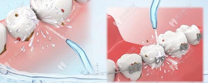 洗牙可是不會疼的，就是有點小麻