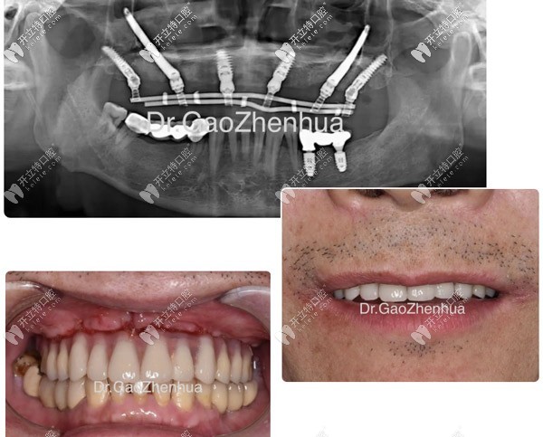 種植牙失敗后他從廣州飛上海再次做了VIIV穿顴穿翼植牙手術(shù)