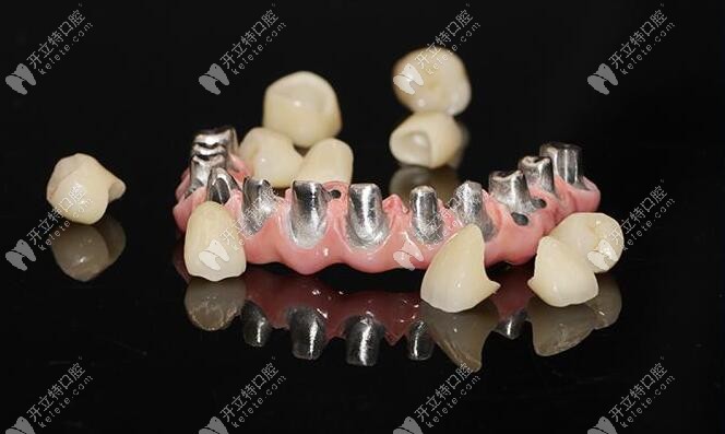 為了研究馬龍橋種植修復是什么,我把優(yōu)缺點和原理都搞懂了