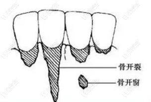 好怕怕,矯正骨開窗開裂的人多嗎?什么情況下容易骨開窗開裂