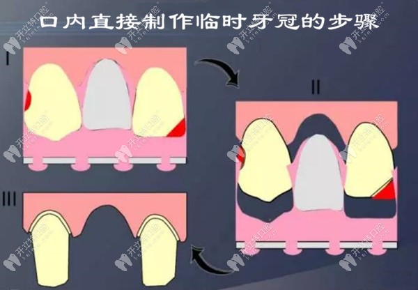 臨時(shí)牙冠口內(nèi)直接制作的步驟